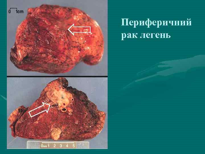 Периферичний рак легень 