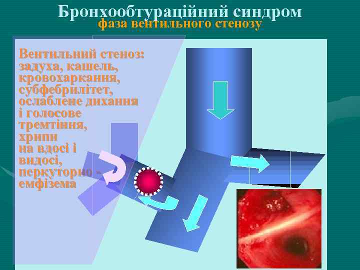 Бронхообтураційний синдром фаза вентильного стенозу Вентильний стеноз: задуха, кашель, кровохаркання, субфебрилітет, ослаблене дихання і