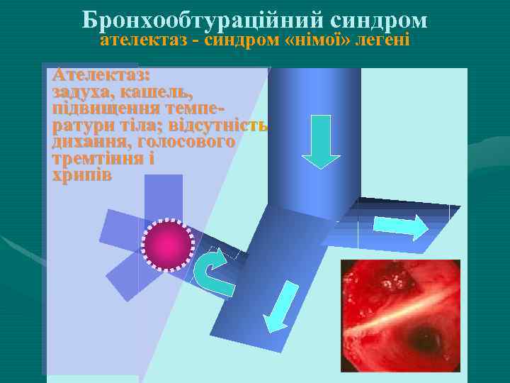 Бронхообтураційний синдром ателектаз - синдром «німої» легені Ателектаз: задуха, кашель, підвищення температури тіла; відсутність