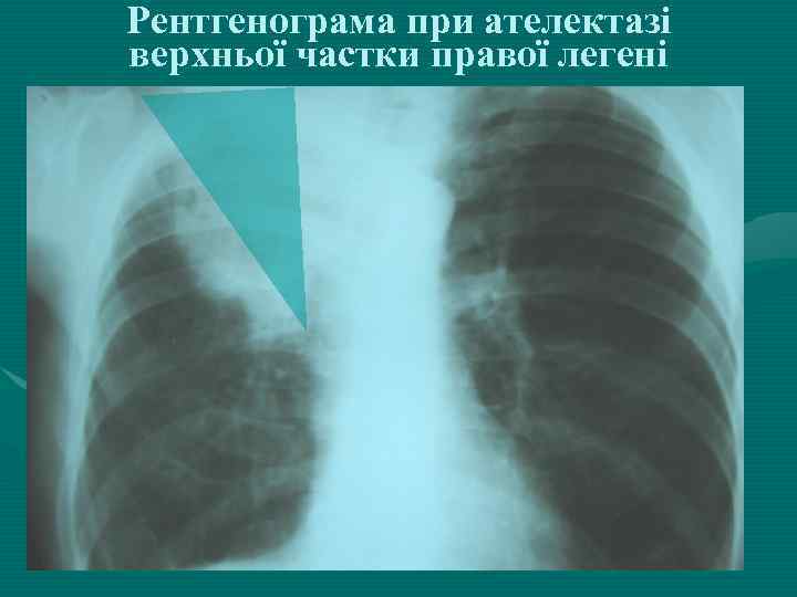 Рентгенограма при ателектазі верхньої частки правої легені 