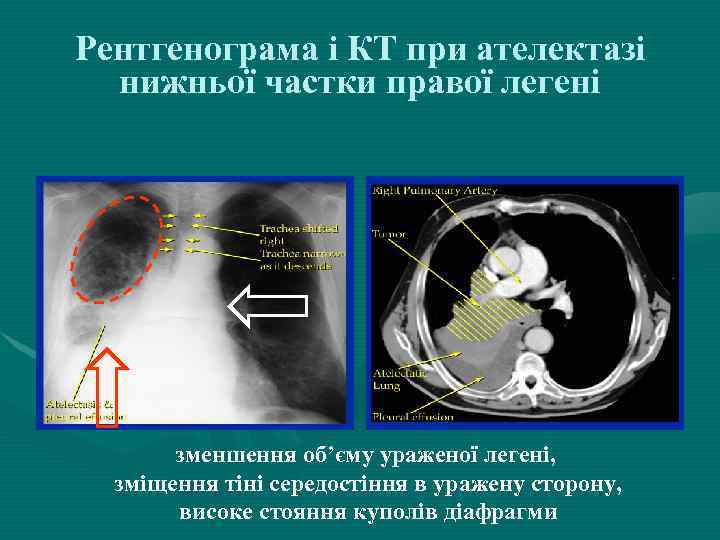 Рентгенограма і КТ при ателектазі нижньої частки правої легені зменшення об’єму ураженої легені, зміщення