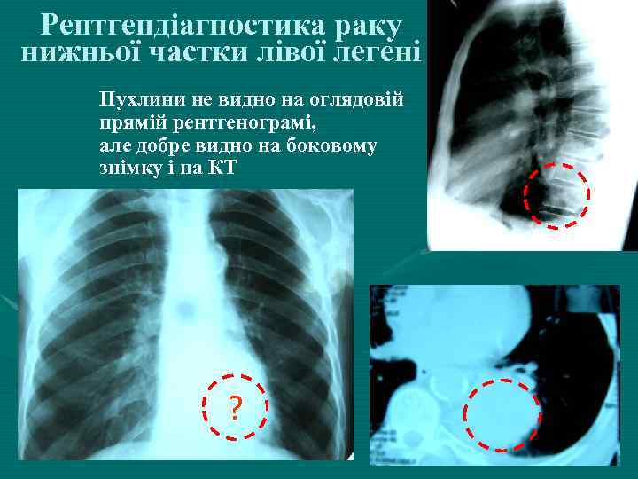 Рентгендіагностика раку нижньої частки лівої легені Пухлини не видно на оглядовій прямій рентгенограмі, але