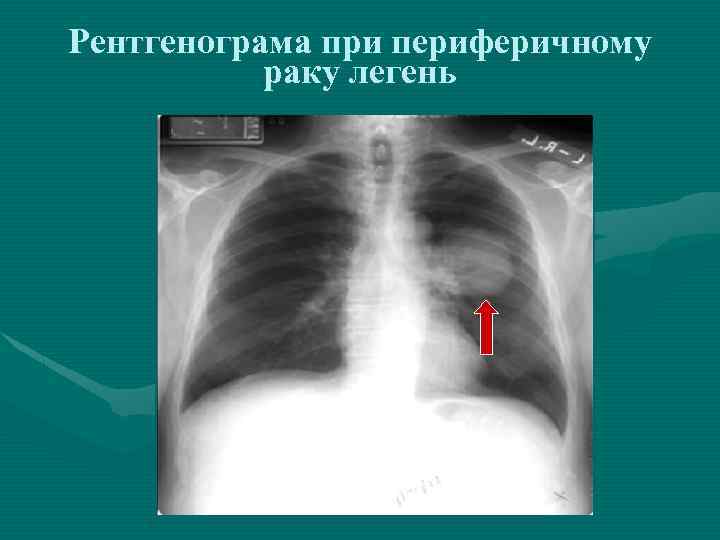 Рентгенограма при периферичному раку легень 