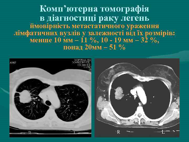 Комп’ютерна томографія в діагностиці раку легень ймовірність метастатичного ураження лімфатичних вузлів у залежності від