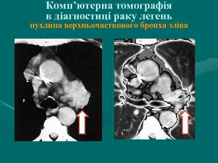 Комп’ютерна томографія в діагностиці раку легень пухлина верхньочасткового бронха зліва 