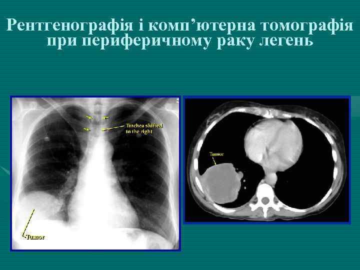 Рентгенографія і комп’ютерна томографія при периферичному раку легень 