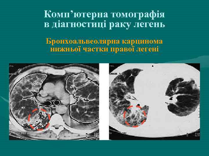 Комп’ютерна томографія в діагностиці раку легень Бронхоальвеолярна карцинома нижньої частки правої легені 