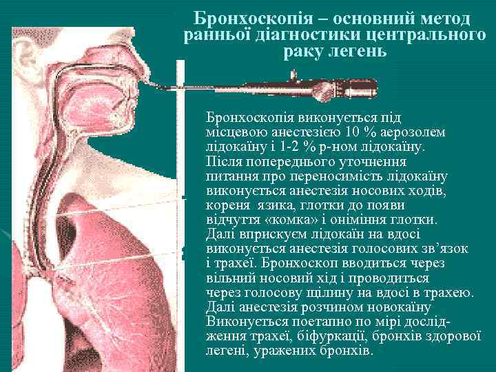 Бронхоскопія – основний метод ранньої діагностики центрального раку легень • Докторna. by Бронхоскопія виконується