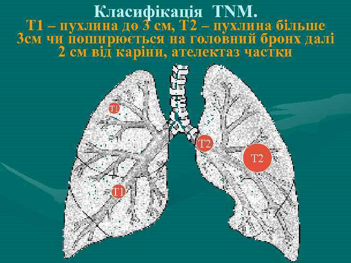 Класифікація TNM. Т 1 – пухлина до 3 см, Т 2 – пухлина більше