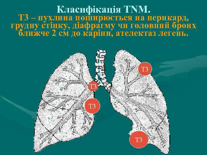 Класифікація ТNM. Т 3 – пухлина поширюється на перикард, грудну стінку, діафрагму чи головний