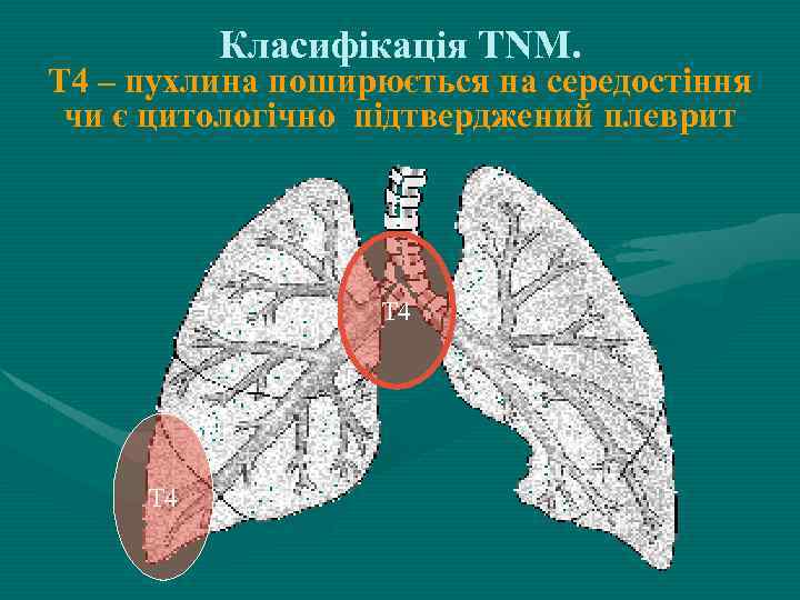 Класифікація ТNM. Т 4 – пухлина поширюється на середостіння чи є цитологічно підтверджений плеврит