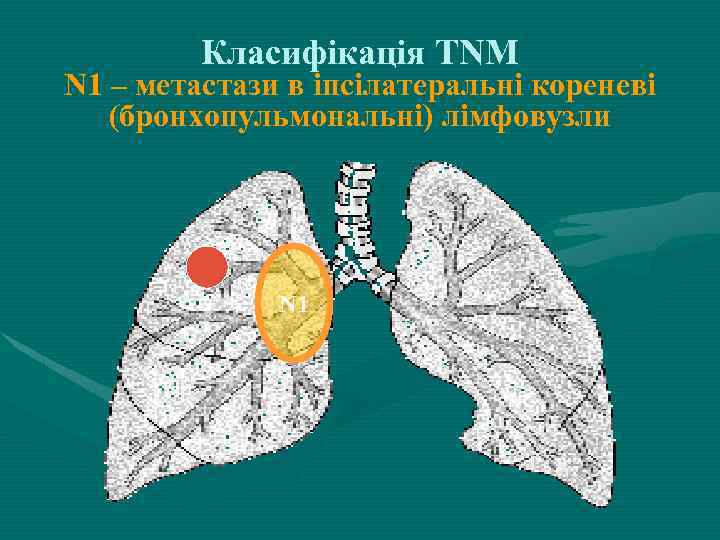 Класифікація ТNM N 1 – метастази в іпсілатеральні кореневі (бронхопульмональні) лімфовузли N 1 