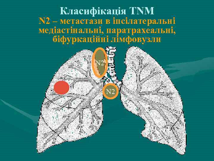 Класифікація ТNM N 2 – метастази в іпсілатеральні медіастінальні, паратрахеальні, біфуркаційні лімфовузли N 2