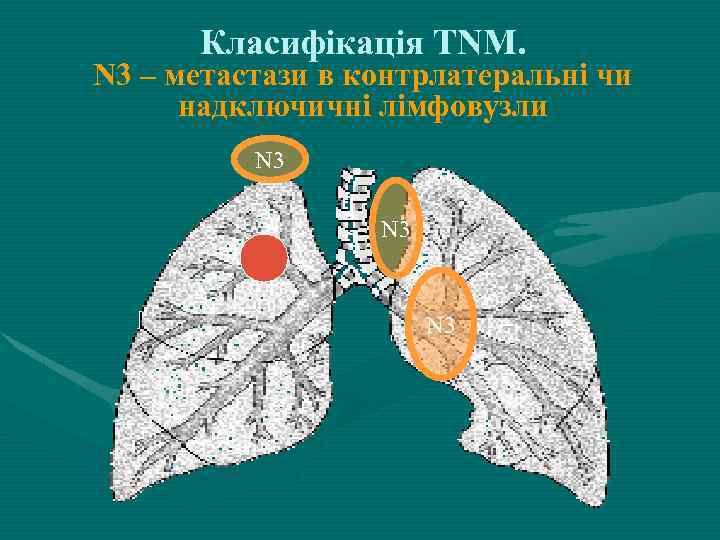 Класифікація ТNM. N 3 – метастази в контрлатеральні чи надключичні лімфовузли N 3 N