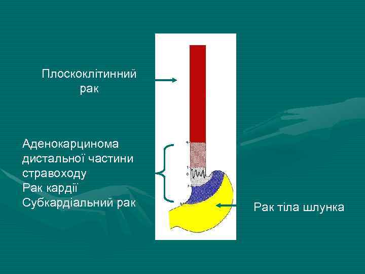 Плоскоклітинний рак Аденокарцинома дистальної частини стравоходу Рак кардії Субкардіальний рак Рак тіла шлунка 