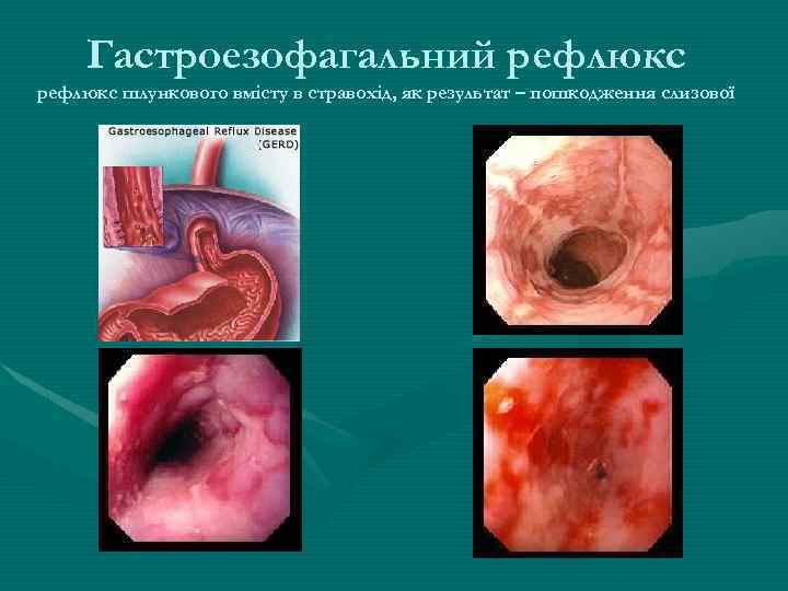 Гастроезофагальний рефлюкс шлункового вмісту в стравохід, як результат – пошкодження слизової 