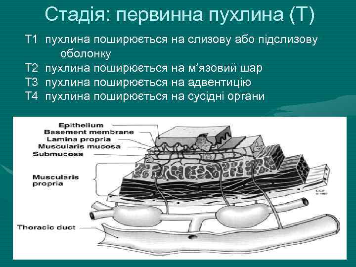 Стадія: первинна пухлина (T) T 1 пухлина поширюється на слизову або підслизову оболонку T