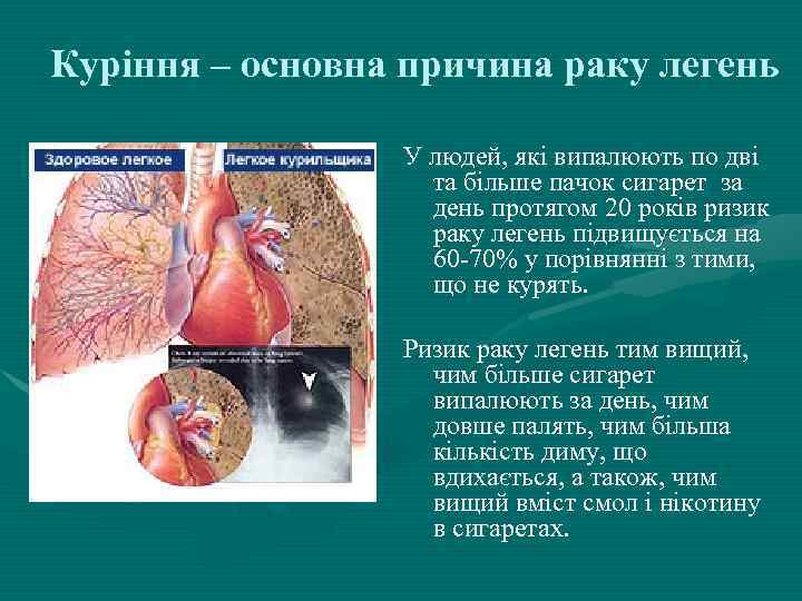 Куріння – основна причина раку легень У людей, які випалюють по дві та більше