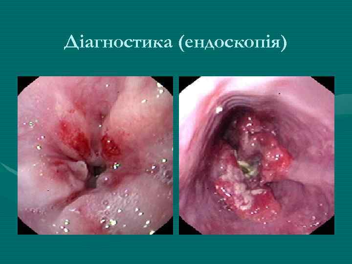 Діагностика (ендоскопія) 