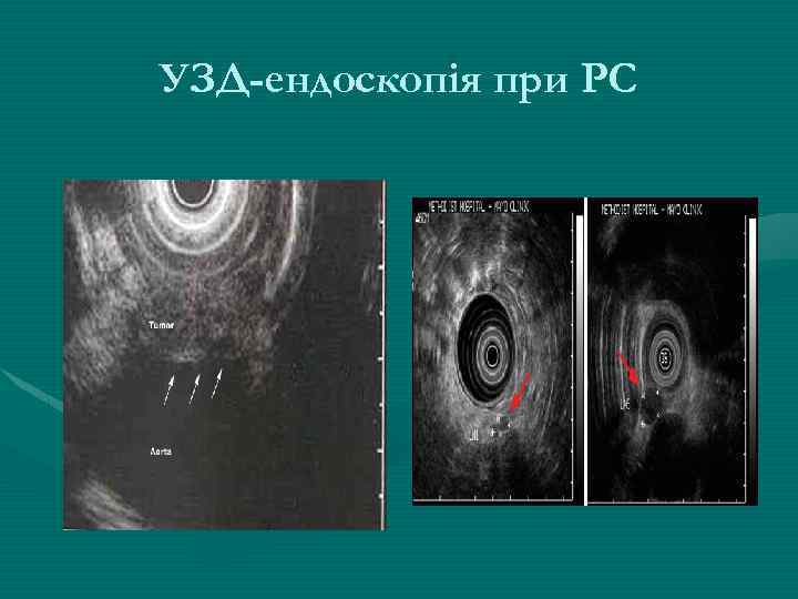 УЗД-ендоскопія при РС 