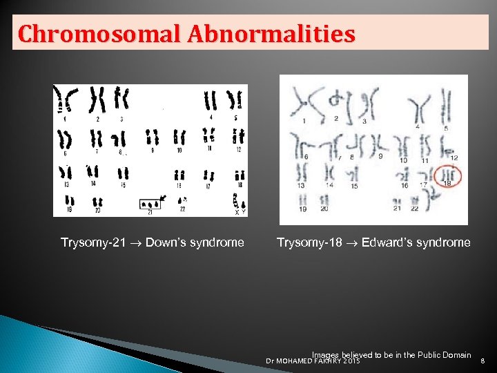 Chromosomal Abnormalities Trysomy-21 Down’s syndrome Trysomy-18 Edward’s syndrome Images believed to be in the