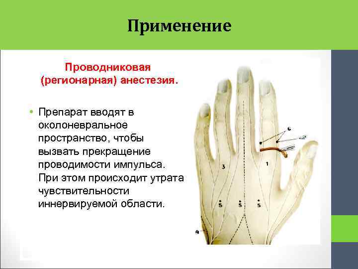 Применение Проводниковая (регионарная) анестезия. • Препарат вводят в околоневральное пространство, чтобы вызвать прекращение проводимости