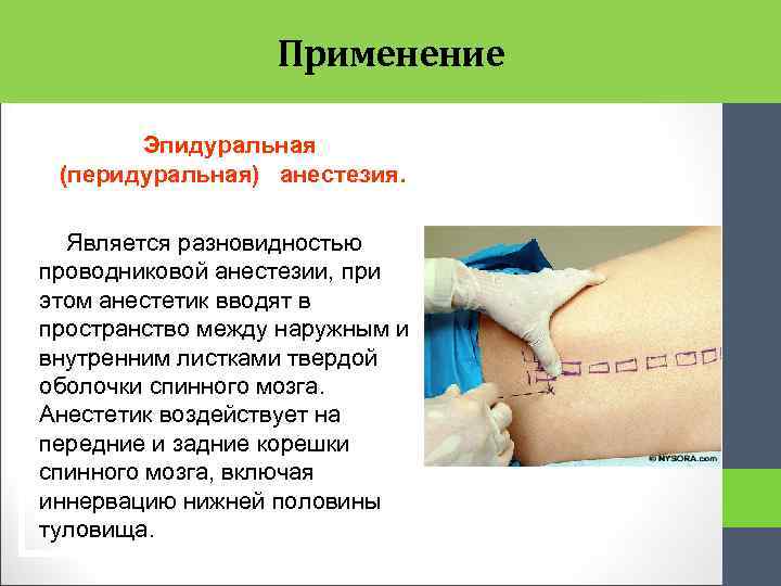 Применение Эпидуральная (перидуральная) анестезия. Является разновидностью проводниковой анестезии, при этом анестетик вводят в пространство