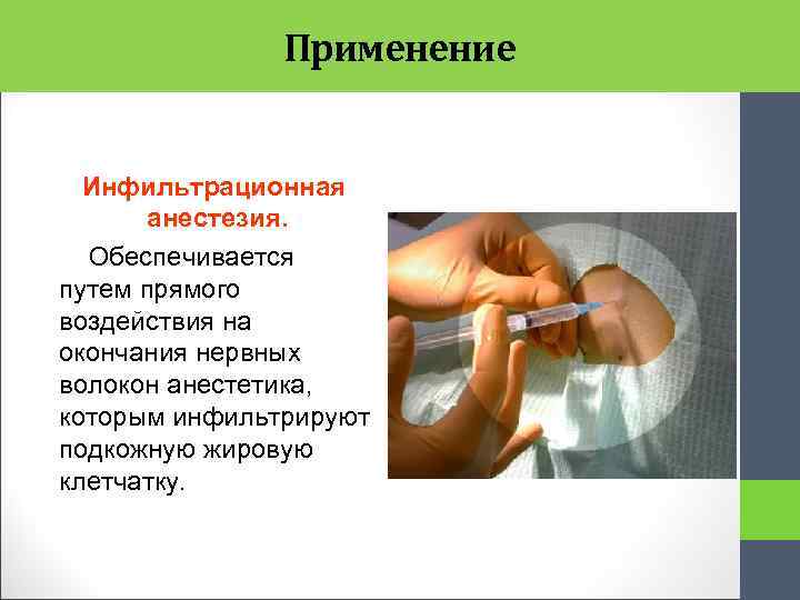 Применение Инфильтрационная анестезия. Обеспечивается путем прямого воздействия на окончания нервных волокон анестетика, которым инфильтрируют