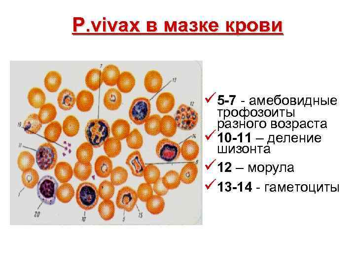 P. vivax в мазке крови ü 5 -7 - амебовидные трофозоиты разного возраста ü
