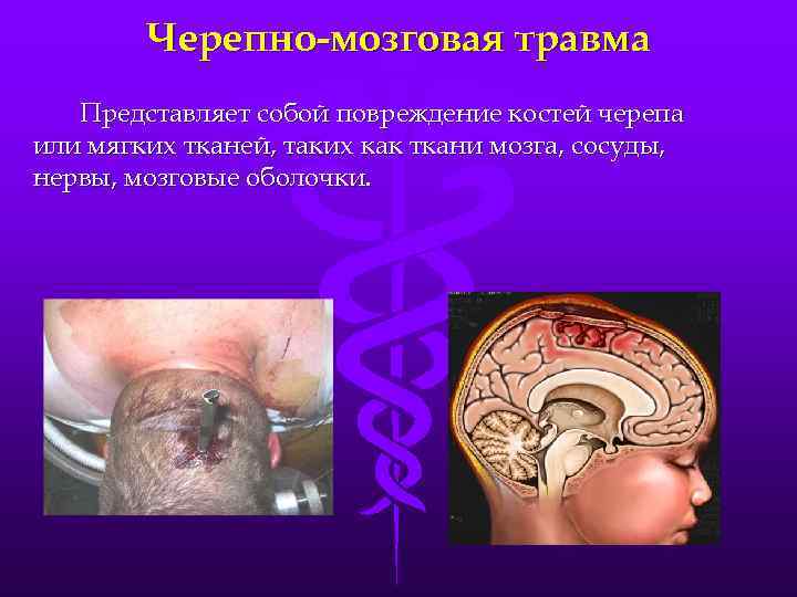 Черепно-мозговая травма Представляет собой повреждение костей черепа или мягких тканей, таких как ткани мозга,