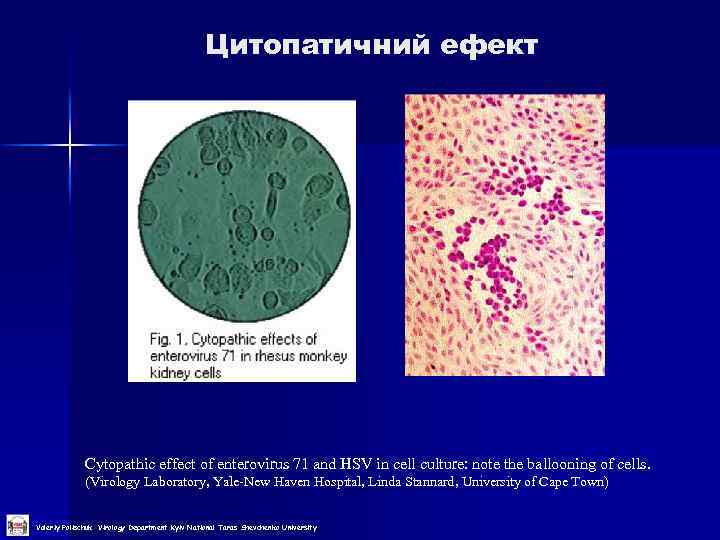 Цитопатичний ефект Cytopathic effect of enterovirus 71 and HSV in cell culture: note the