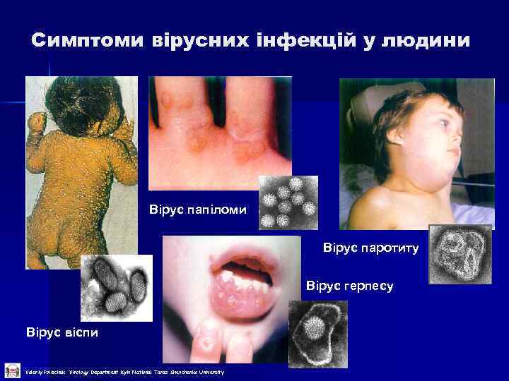 Симптоми вірусних інфекцій у людини Вірус папіломи Вірус паротиту Вірус герпесу Вірус віспи Valeriy