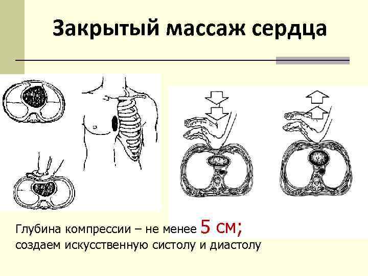 Закрытый массаж сердца Глубина компрессии – не менее 5 см; создаем искусственную систолу и