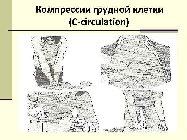 Компрессии грудной клетки (C-circulation) 