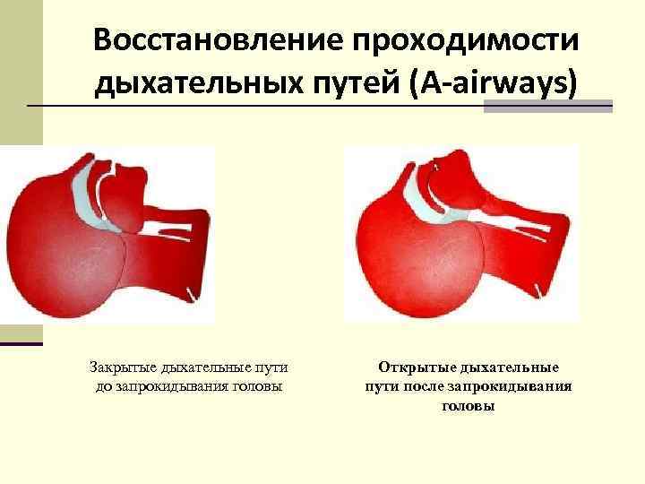 Восстановление проходимости дыхательных путей (А-airways) Закрытые дыхательные пути до запрокидывания головы Открытые дыхательные пути