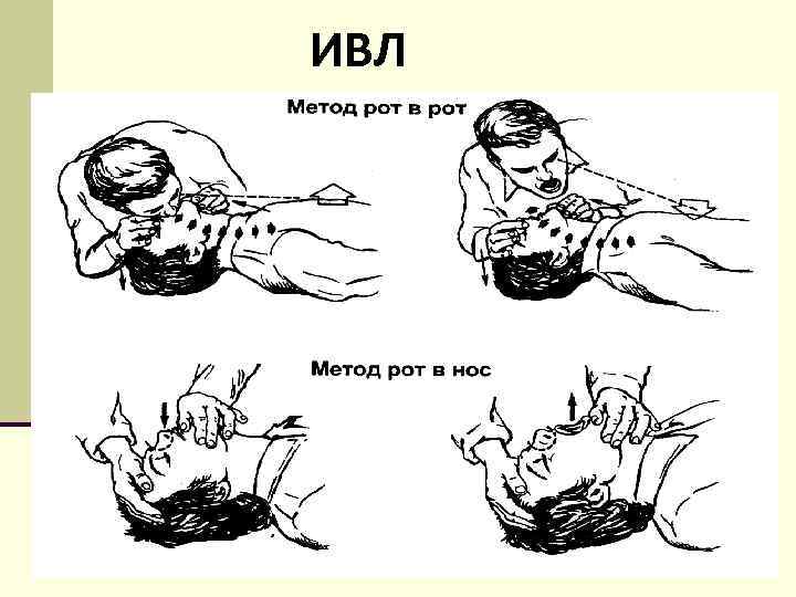 ИВЛ Mouth – to - Nose 
