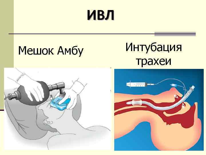 ИВЛ Мешок Амбу Интубация трахеи 