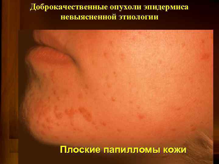 Доброкачественные опухоли эпидермиса невыясненной этиологии Плоские папилломы кожи 
