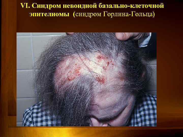 VI. Синдром невоидной базально-клеточной эпителиомы (синдром Горлина-Гольца) 