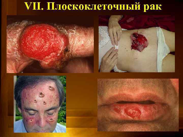 VII. Плоскоклеточный рак 