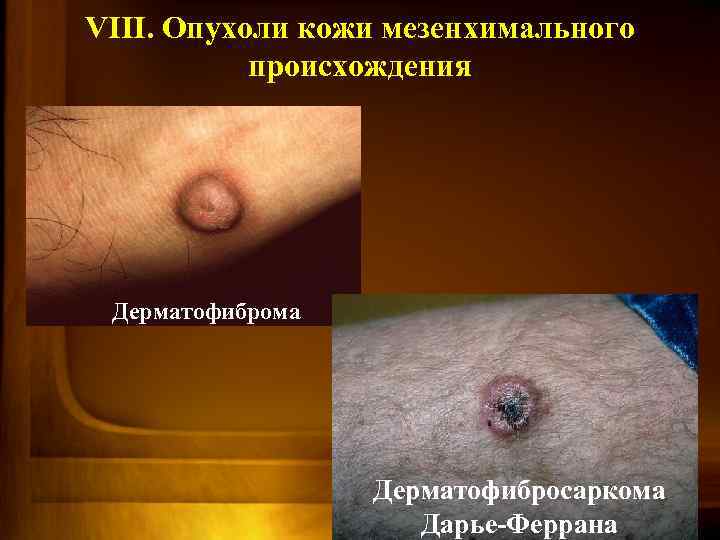 VIII. Опухоли кожи мезенхимального происхождения Дерматофиброма Дерматофибросаркома Дарье-Феррана 