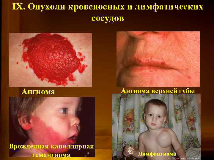 IX. Опухоли кровеносных и лимфатических сосудов Ангиома Врожденная капиллярная гемангиома Ангиома верхней губы Лимфангиома