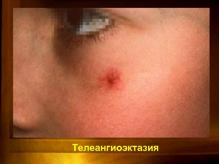 Телеангиоэктазия 