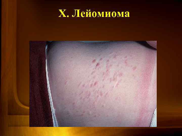 X. Лейомиома 