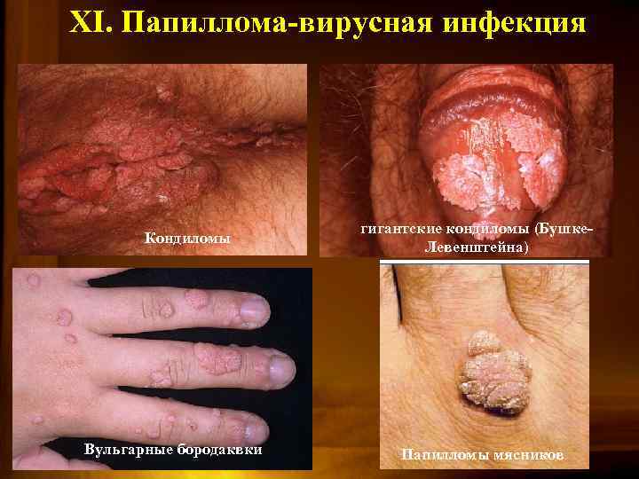 XI. Папиллома-вирусная инфекция Кондиломы Вульгарные бородаквки гигантские кондиломы (Бушке. Левенштейна) Папилломы мясников 