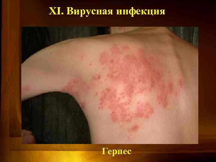 XI. Вирусная инфекция Герпес 
