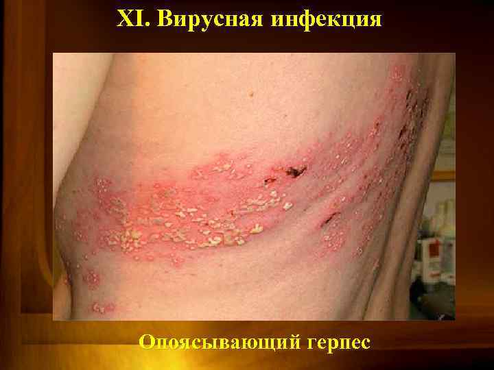 XI. Вирусная инфекция Опоясывающий герпес 
