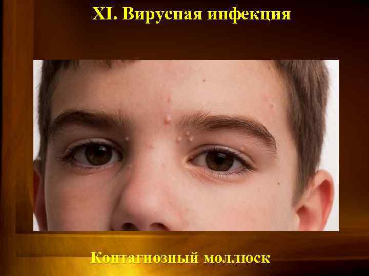 XI. Вирусная инфекция Контагиозный моллюск 
