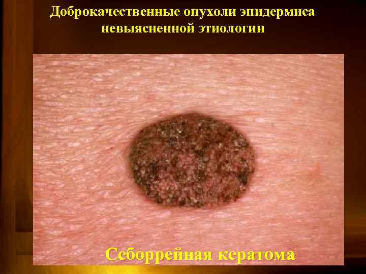 Доброкачественные опухоли эпидермиса невыясненной этиологии Себоррейная кератома 