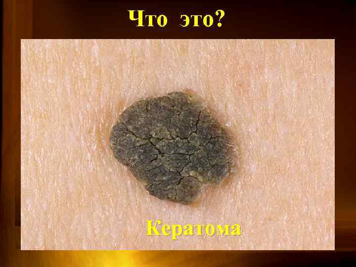 Что это? Кератома 